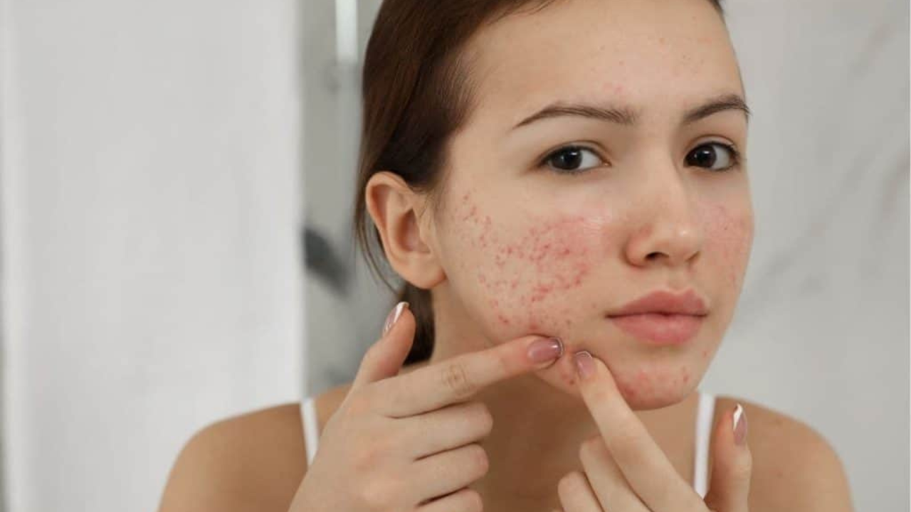 The Quest to Clear Skin: Choosing the Best Probiotic Supplement For Acne